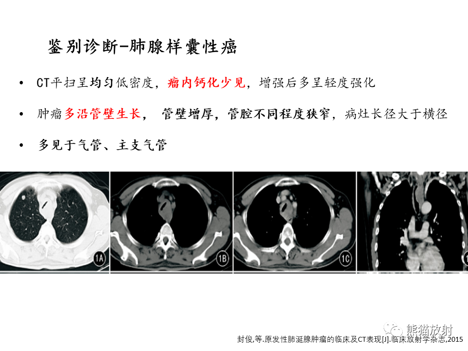 影像PPT - 【病例】支气管粘液表皮样癌2例CT影像-35