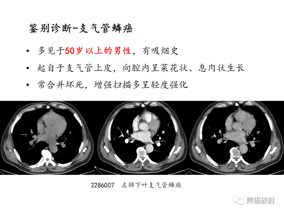 影像PPT - 【病例】支气管粘液表皮样癌2例CT影像-42