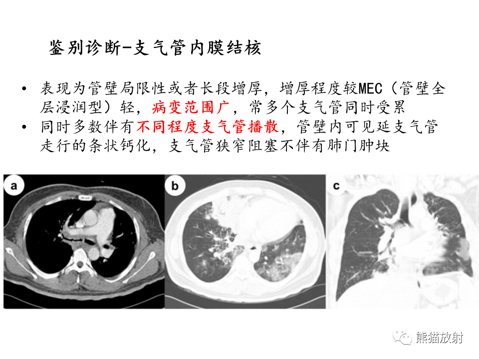 影像PPT - 【病例】支气管粘液表皮样癌2例CT影像-43