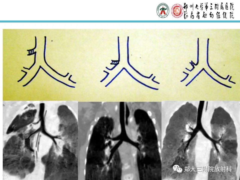 影像PPT - 【PPT】小儿气管及支气管发育畸形的CT诊断-4