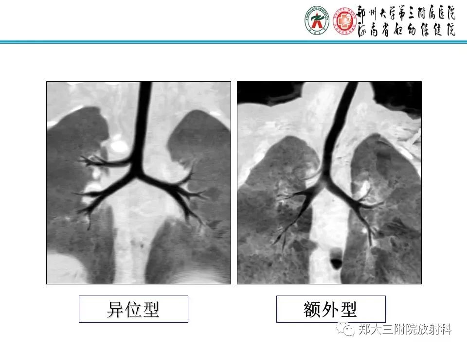 影像PPT - 【PPT】小儿气管及支气管发育畸形的CT诊断-6