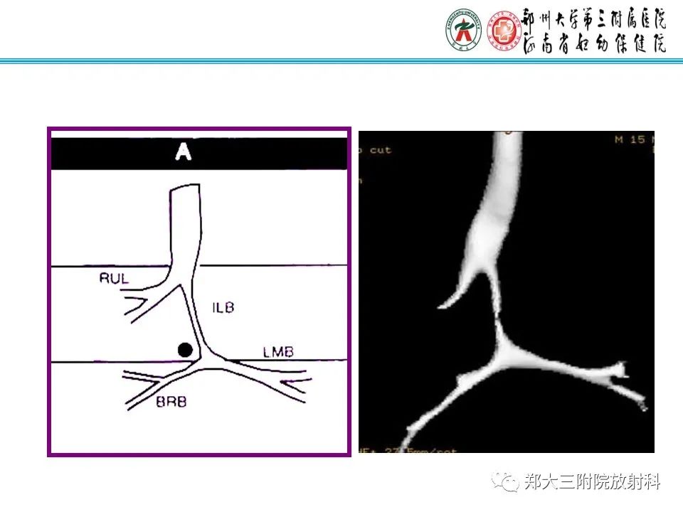影像PPT - 【PPT】小儿气管及支气管发育畸形的CT诊断-14