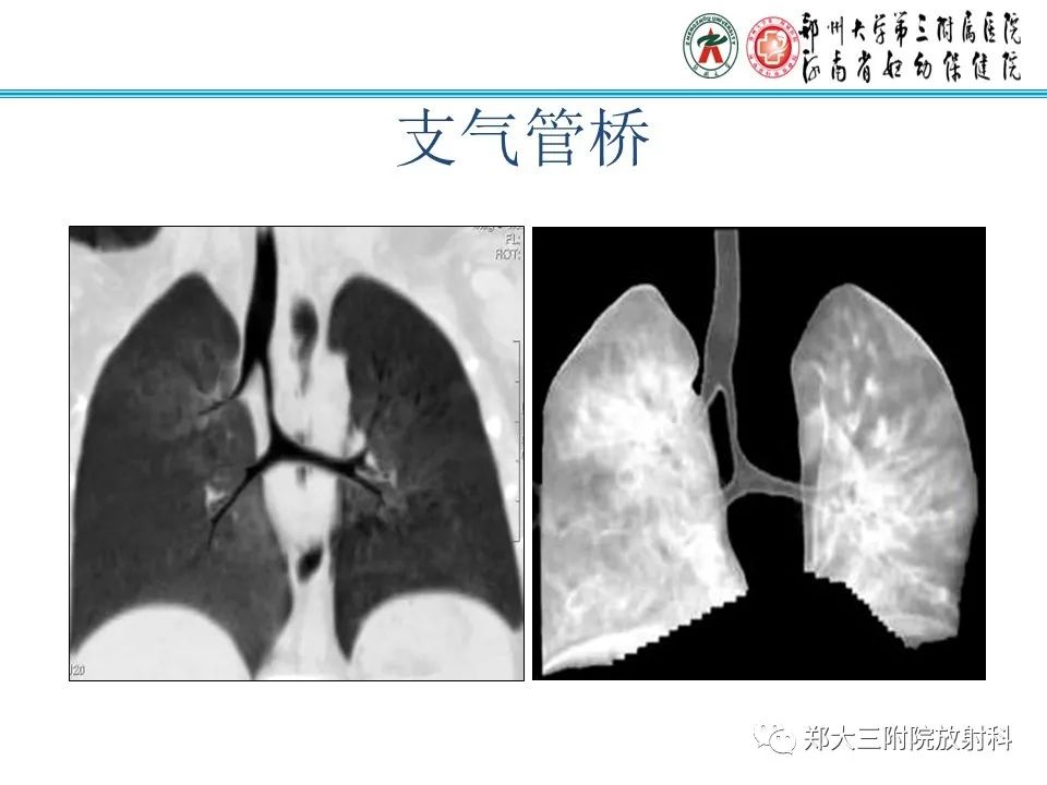 影像PPT - 【PPT】小儿气管及支气管发育畸形的CT诊断-15