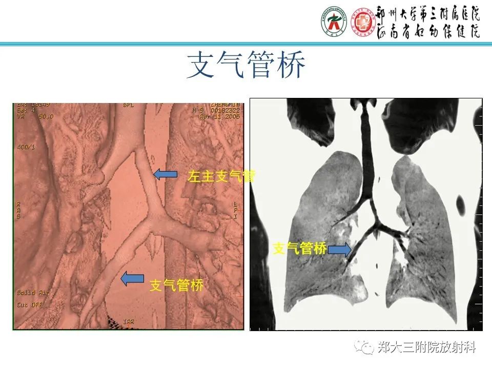 影像PPT - 【PPT】小儿气管及支气管发育畸形的CT诊断-16