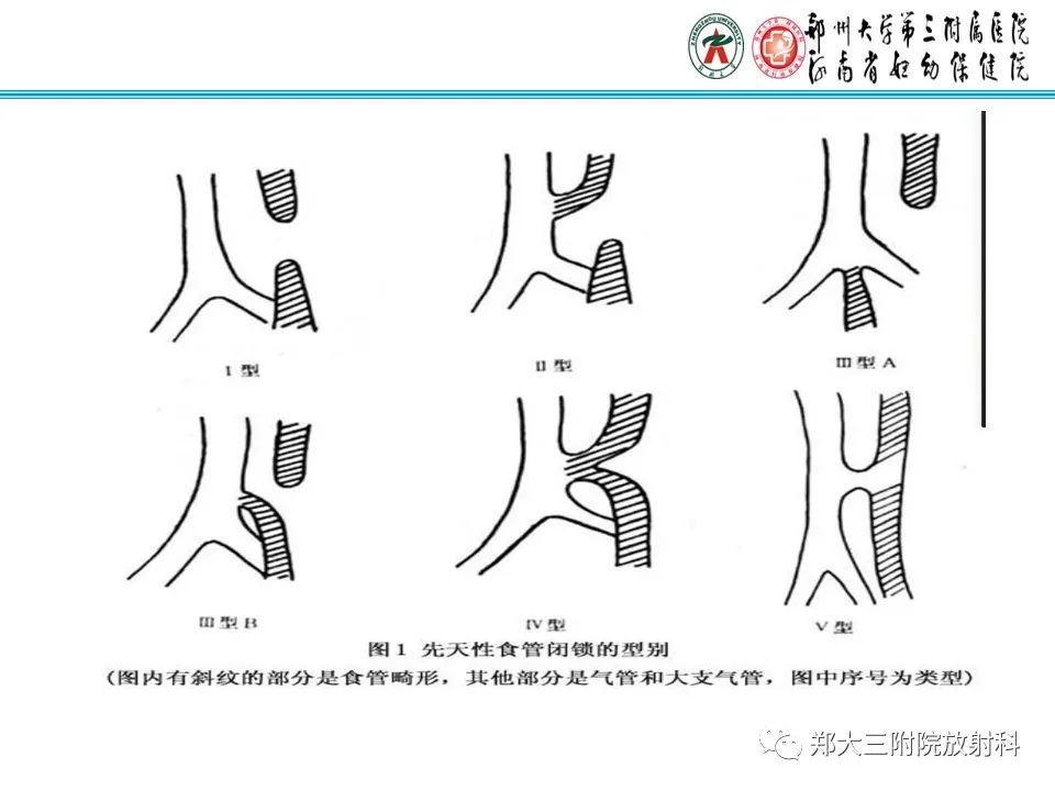 影像PPT - 【PPT】小儿气管及支气管发育畸形的CT诊断-21