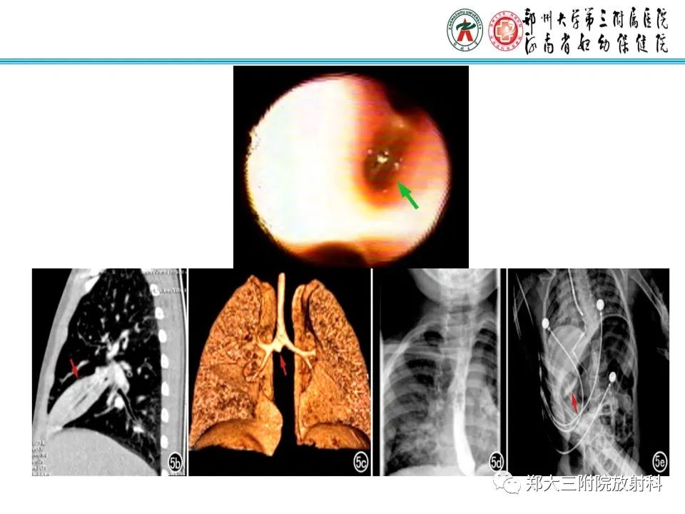 影像PPT - 【PPT】小儿气管及支气管发育畸形的CT诊断-24