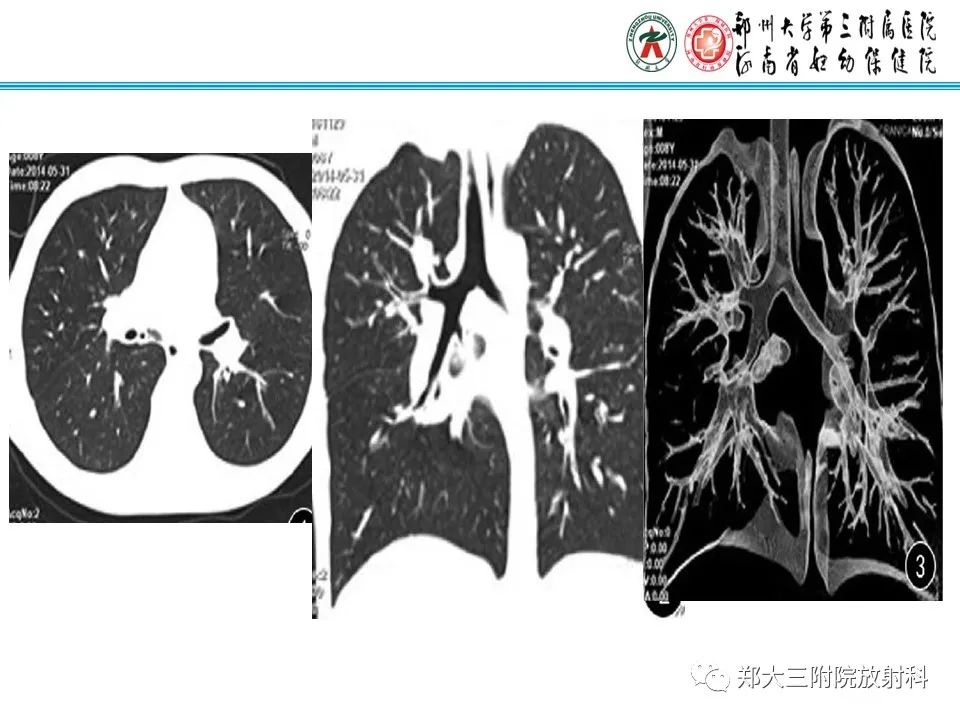 影像PPT - 【PPT】小儿气管及支气管发育畸形的CT诊断-28