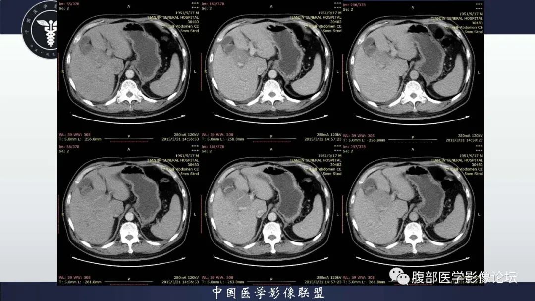 影像PPT - 【病例】肝脏淋巴瘤2例CT及MR影像-4