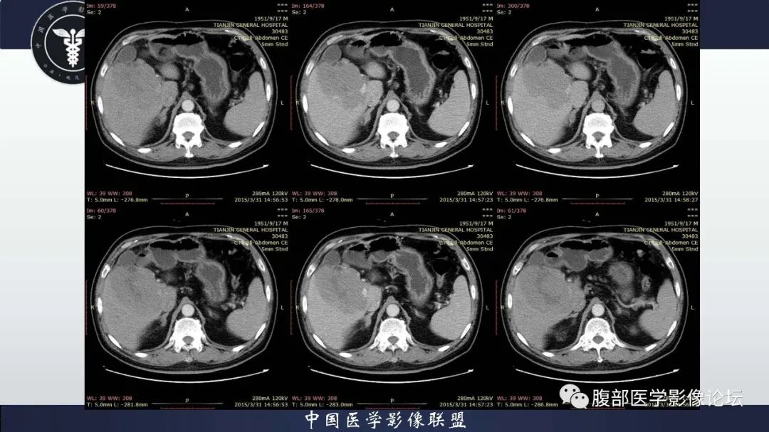 影像PPT - 【病例】肝脏淋巴瘤2例CT及MR影像-5