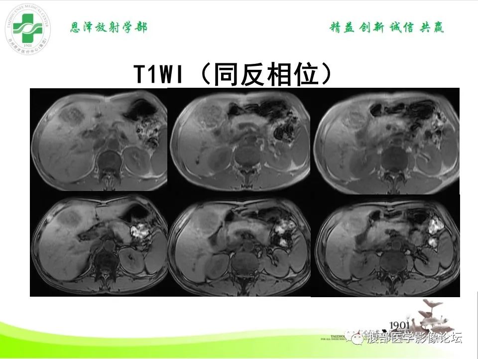 影像PPT - 【病例】肝脏淋巴瘤2例CT及MR影像-13