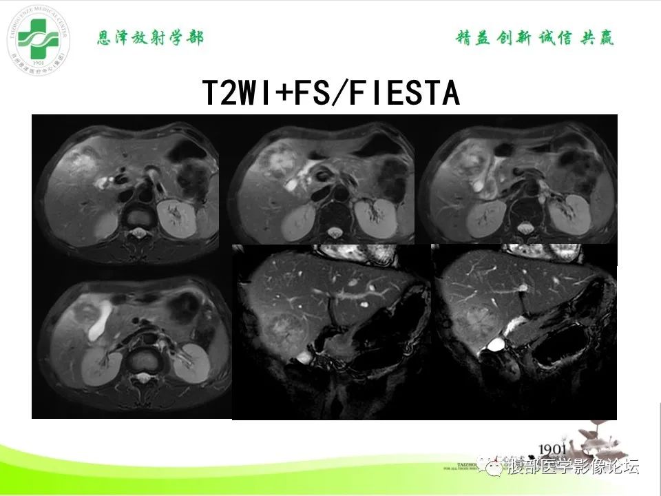 影像PPT - 【病例】肝脏淋巴瘤2例CT及MR影像-14