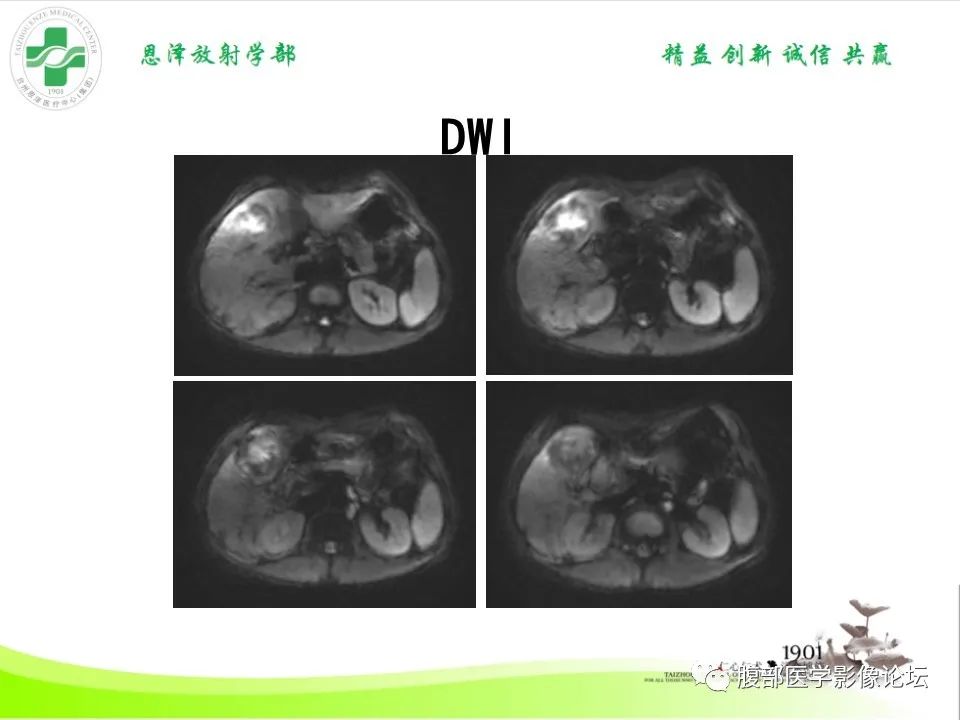 影像PPT - 【病例】肝脏淋巴瘤2例CT及MR影像-15