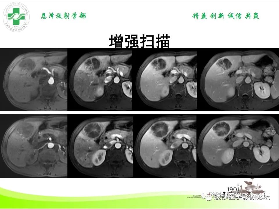 影像PPT - 【病例】肝脏淋巴瘤2例CT及MR影像-17