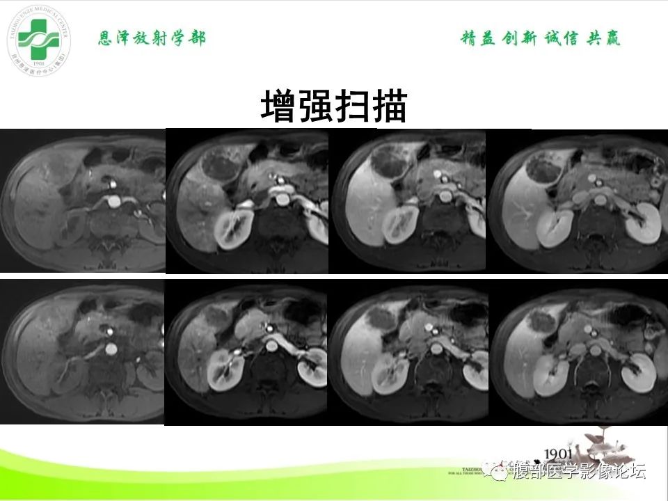 影像PPT - 【病例】肝脏淋巴瘤2例CT及MR影像-18