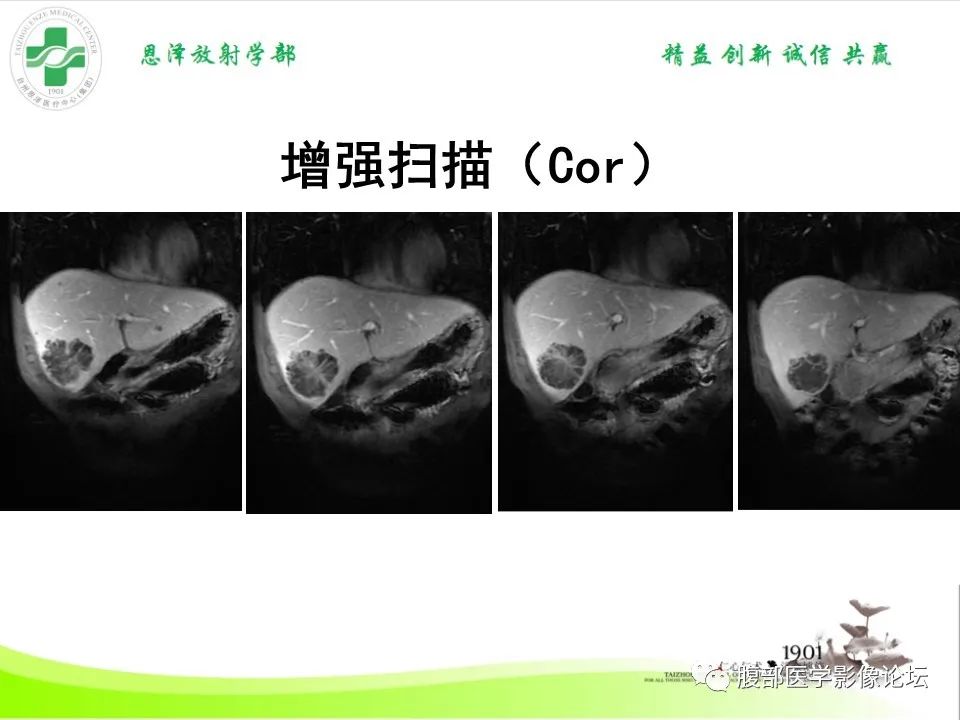 影像PPT - 【病例】肝脏淋巴瘤2例CT及MR影像-19