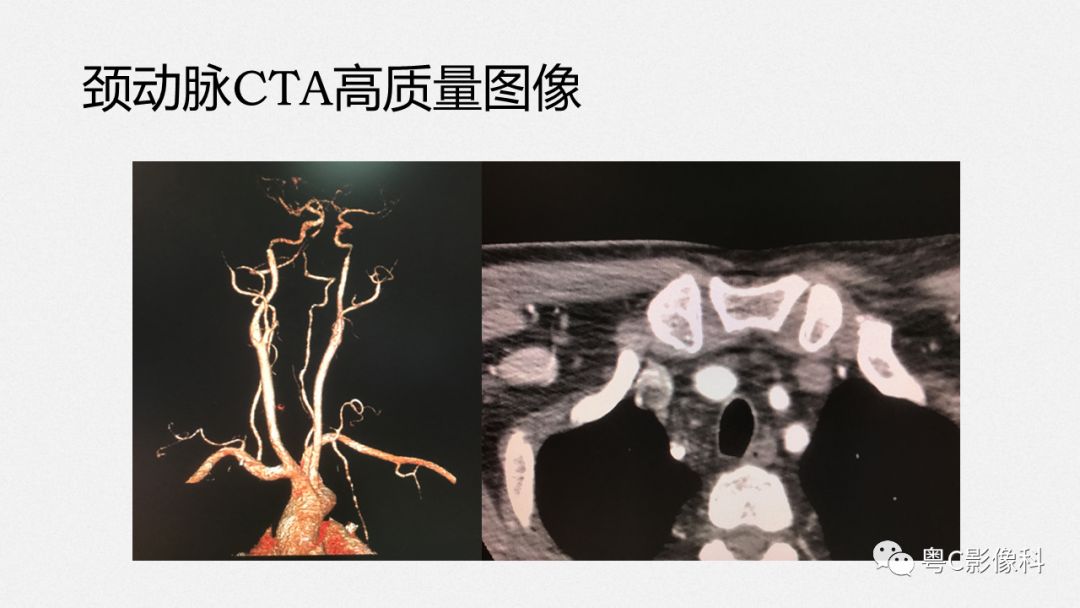 影像PPT - 【PPT】颈动脉CTA检查——How to do well?-2