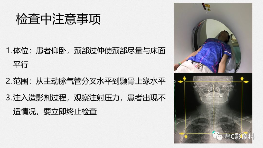 影像PPT - 【PPT】颈动脉CTA检查——How to do well?-12