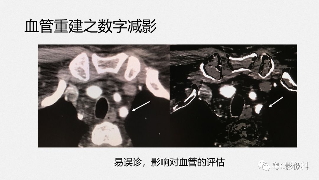 影像PPT - 【PPT】颈动脉CTA检查——How to do well?-18