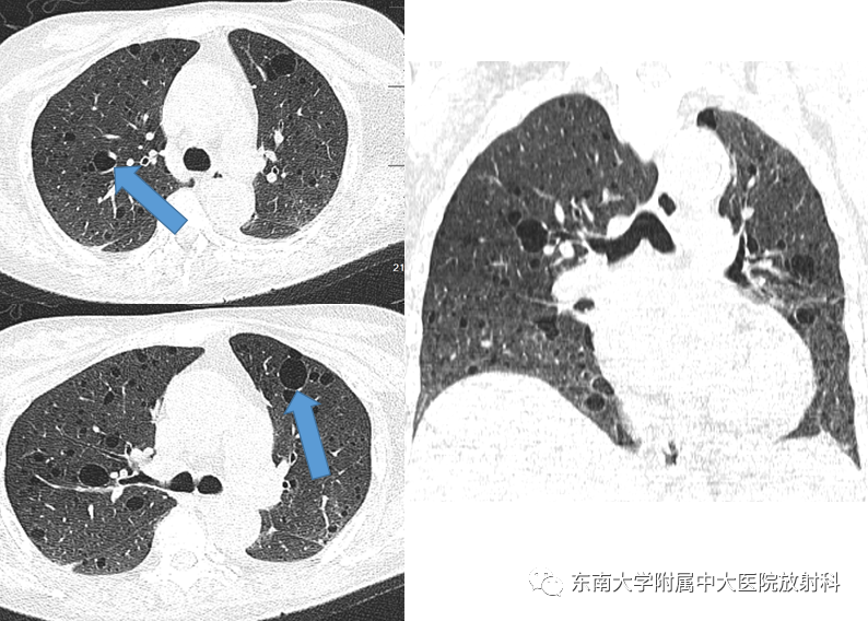 影像PPT - 【病例】肺淋巴管肌瘤病1例CT影像-1