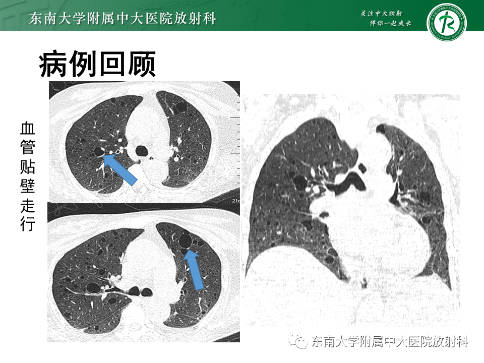 影像PPT - 【病例】肺淋巴管肌瘤病1例CT影像-3