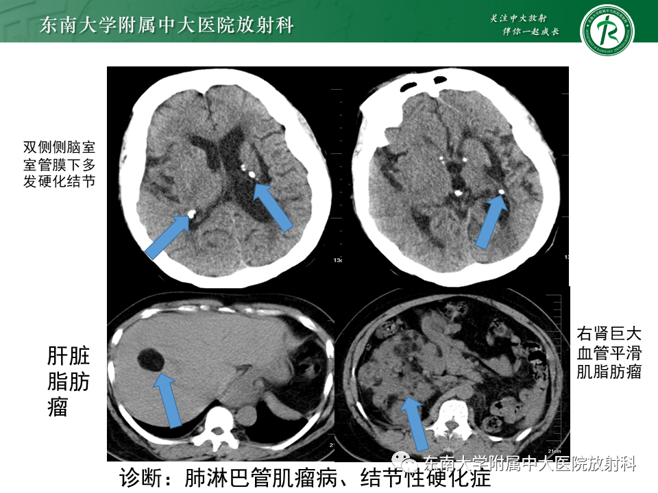 影像PPT - 【病例】肺淋巴管肌瘤病1例CT影像-4