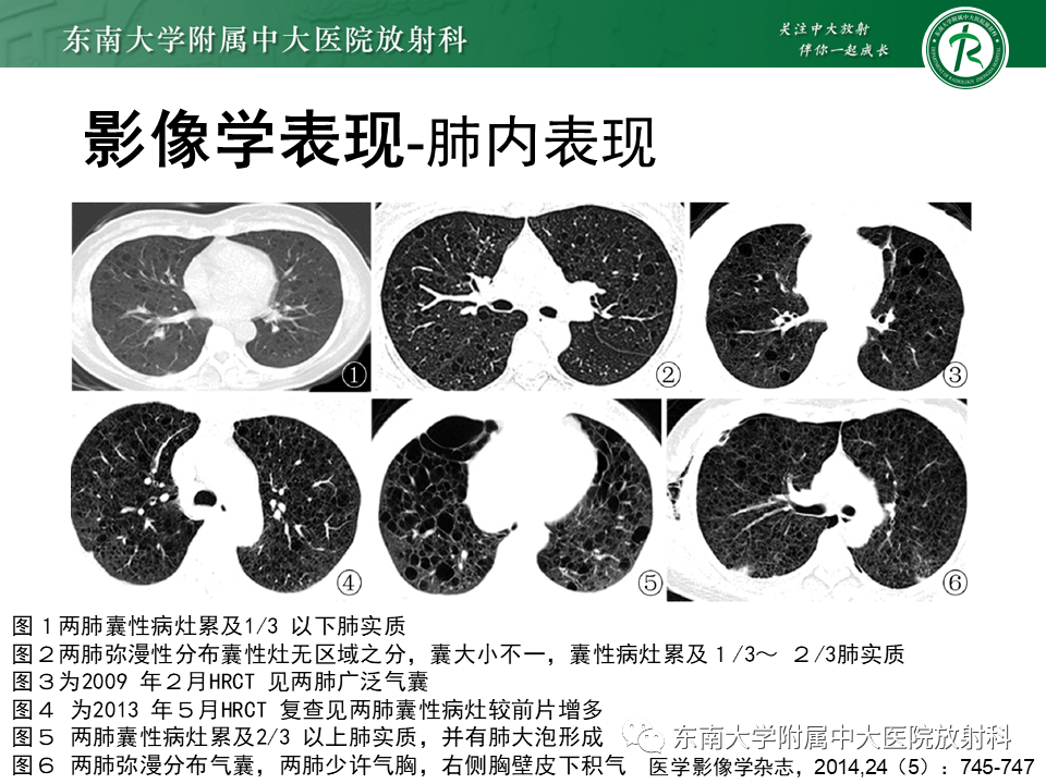 影像PPT - 【病例】肺淋巴管肌瘤病1例CT影像-15