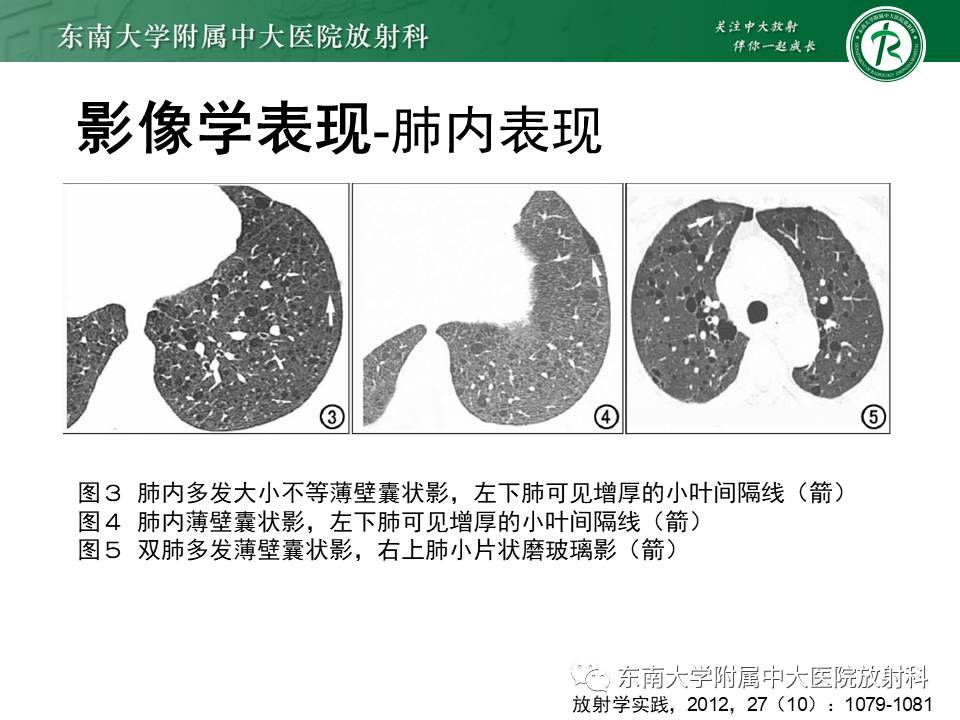 影像PPT - 【病例】肺淋巴管肌瘤病1例CT影像-16