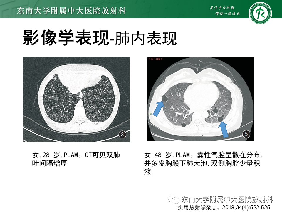 影像PPT - 【病例】肺淋巴管肌瘤病1例CT影像-17