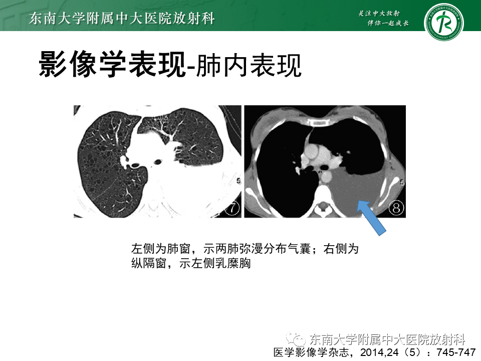 影像PPT - 【病例】肺淋巴管肌瘤病1例CT影像-18