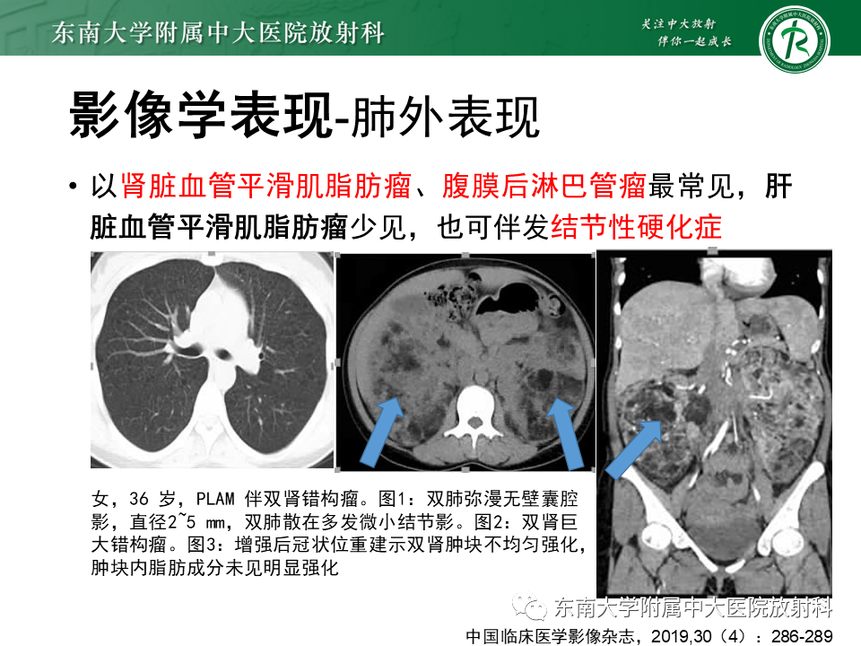 影像PPT - 【病例】肺淋巴管肌瘤病1例CT影像-19