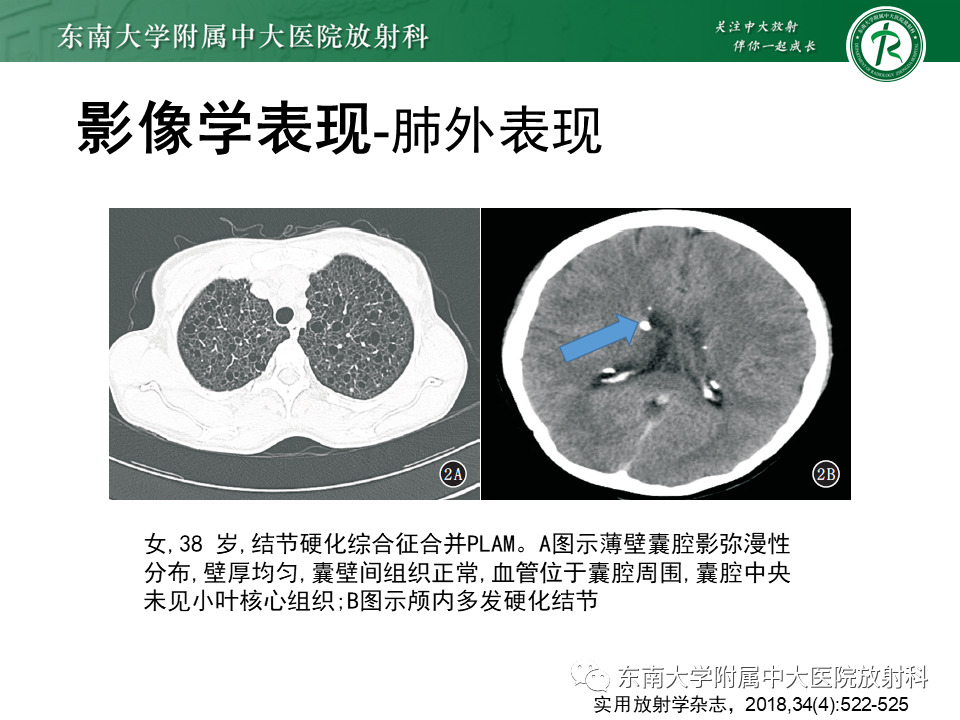影像PPT - 【病例】肺淋巴管肌瘤病1例CT影像-20