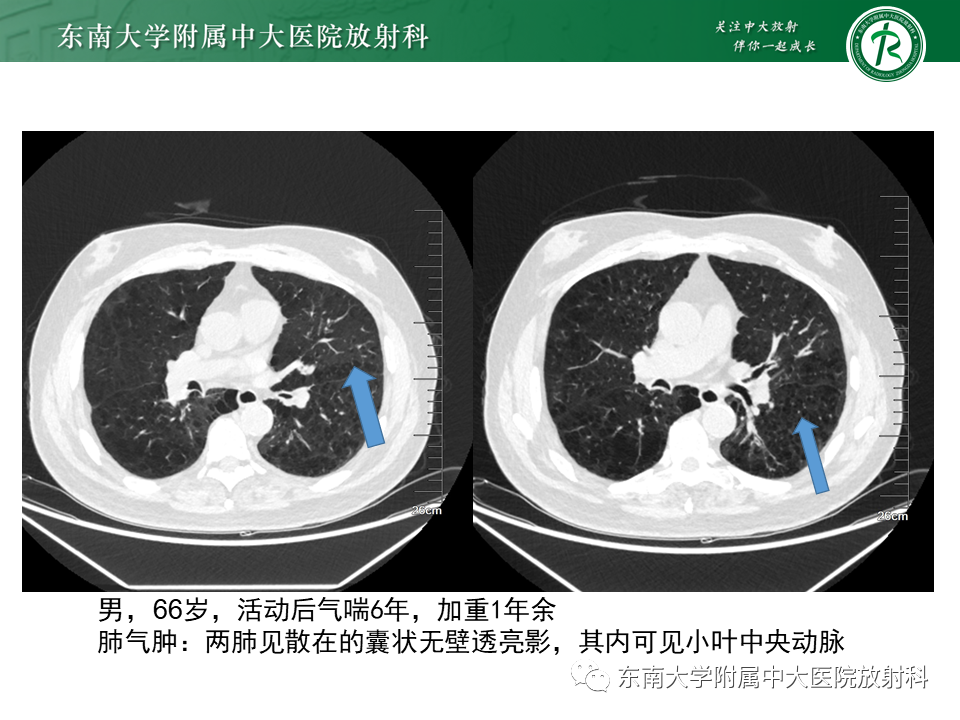 影像PPT - 【病例】肺淋巴管肌瘤病1例CT影像-22