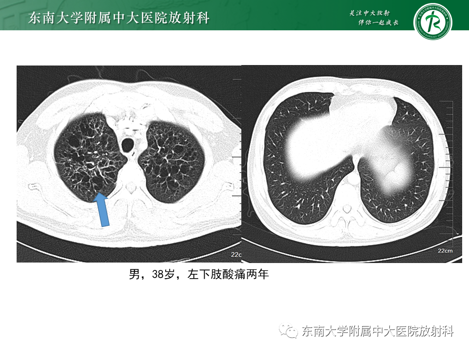 影像PPT - 【病例】肺淋巴管肌瘤病1例CT影像-24