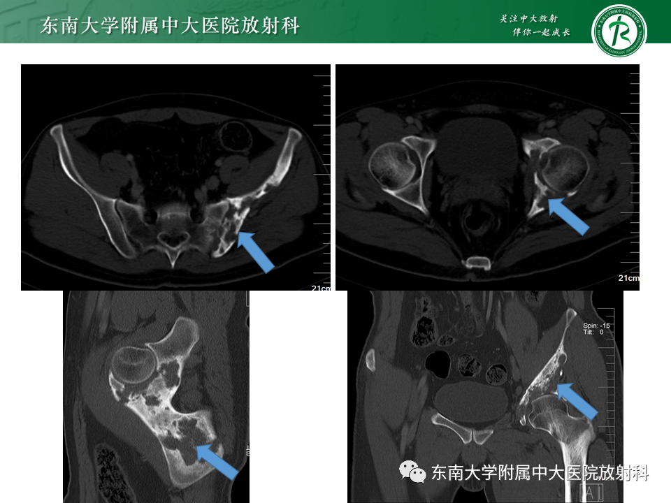 影像PPT - 【病例】肺淋巴管肌瘤病1例CT影像-25