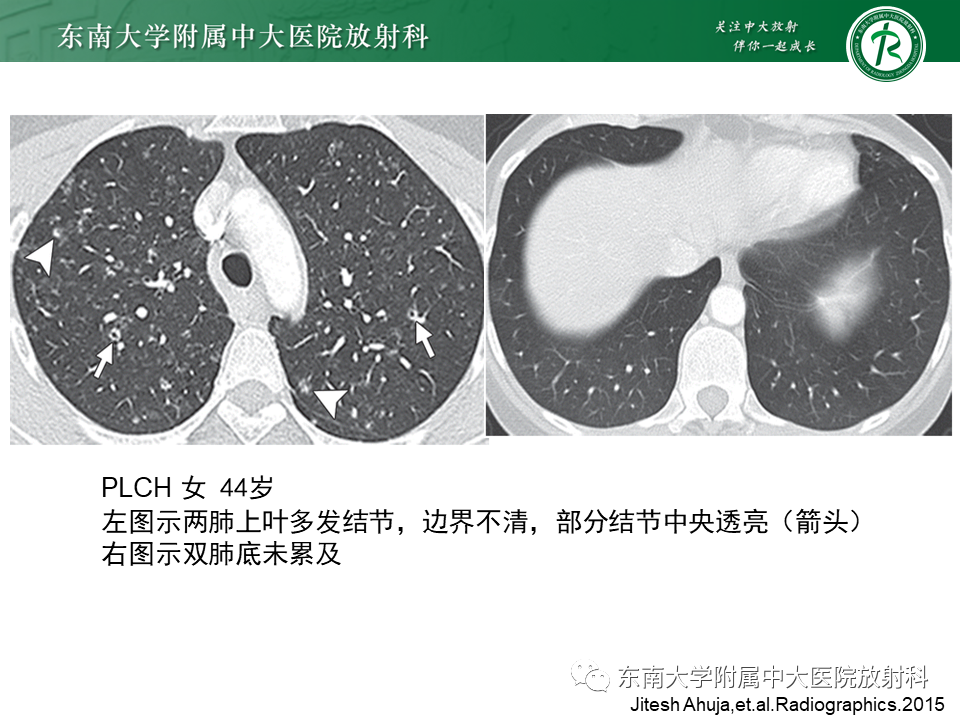 影像PPT - 【病例】肺淋巴管肌瘤病1例CT影像-27