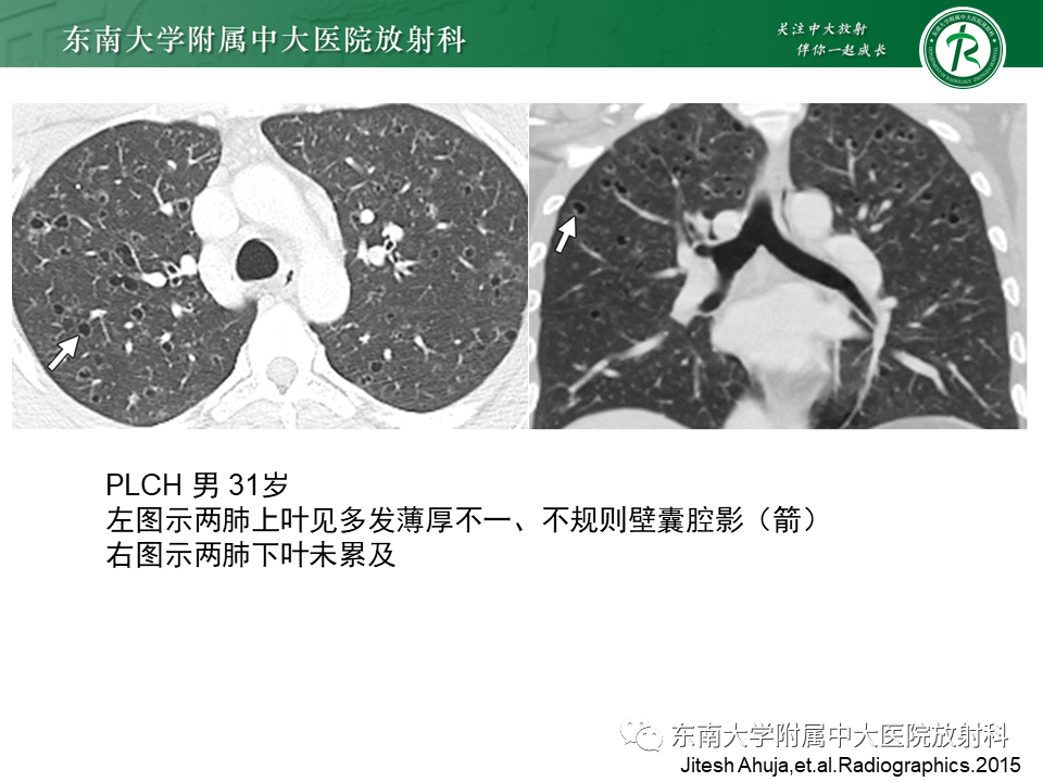 影像PPT - 【病例】肺淋巴管肌瘤病1例CT影像-28