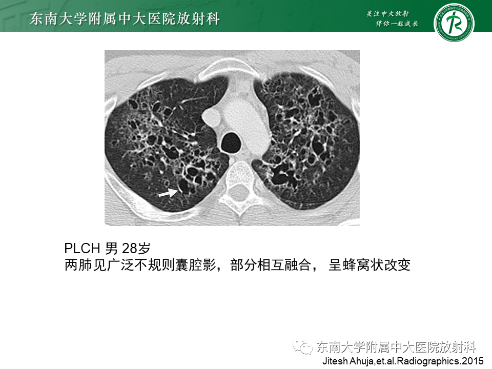影像PPT - 【病例】肺淋巴管肌瘤病1例CT影像-29