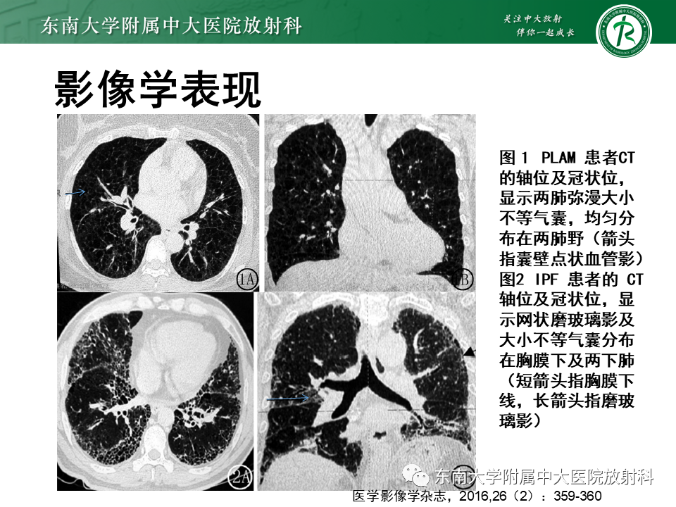 影像PPT - 【病例】肺淋巴管肌瘤病1例CT影像-33