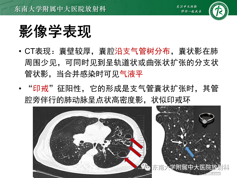 影像PPT - 【病例】肺淋巴管肌瘤病1例CT影像-35