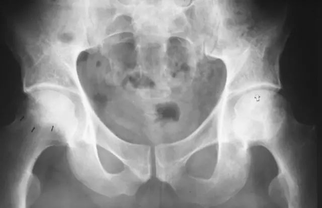 影像PPT - 股骨头缺血坏死的病理基础及影像学表现-6 影像PPT - 股骨头缺血坏死的病理基础及影像学表现-6
