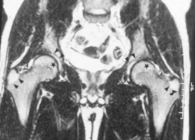 影像PPT - 股骨头缺血坏死的病理基础及影像学表现-8 影像PPT - 股骨头缺血坏死的病理基础及影像学表现-8