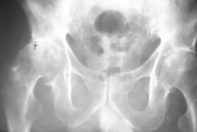 影像PPT - 股骨头缺血坏死的病理基础及影像学表现-10 影像PPT - 股骨头缺血坏死的病理基础及影像学表现-10