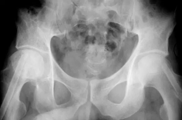 影像PPT - 股骨头缺血坏死的病理基础及影像学表现-13 影像PPT - 股骨头缺血坏死的病理基础及影像学表现-13
