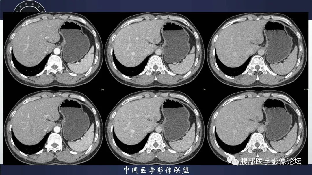 影像PPT - 【病例】肝脏血管平滑肌脂肪瘤1例CT及MR-3