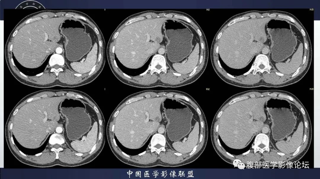 影像PPT - 【病例】肝脏血管平滑肌脂肪瘤1例CT及MR-4