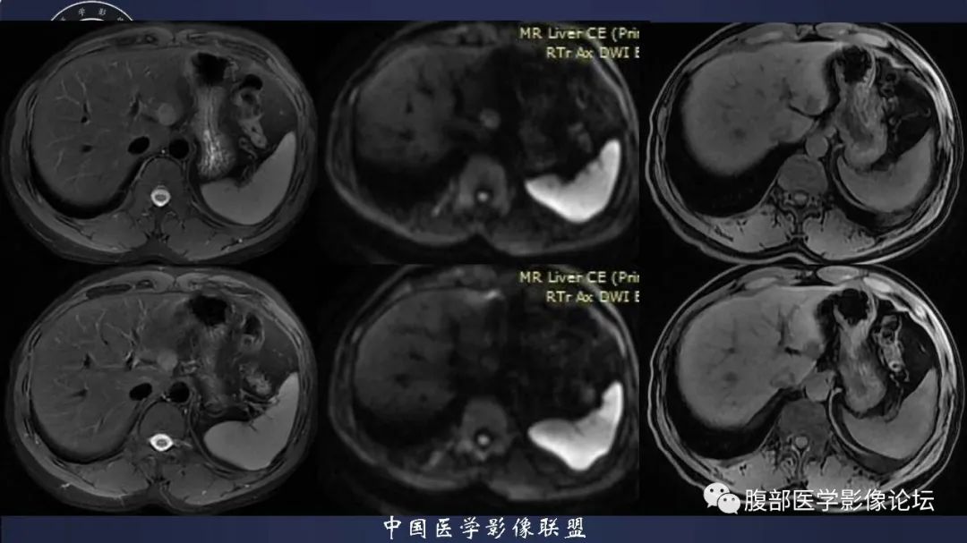影像PPT - 【病例】肝脏血管平滑肌脂肪瘤1例CT及MR-5