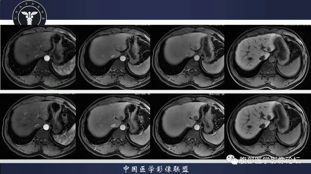 影像PPT - 【病例】肝脏血管平滑肌脂肪瘤1例CT及MR-6