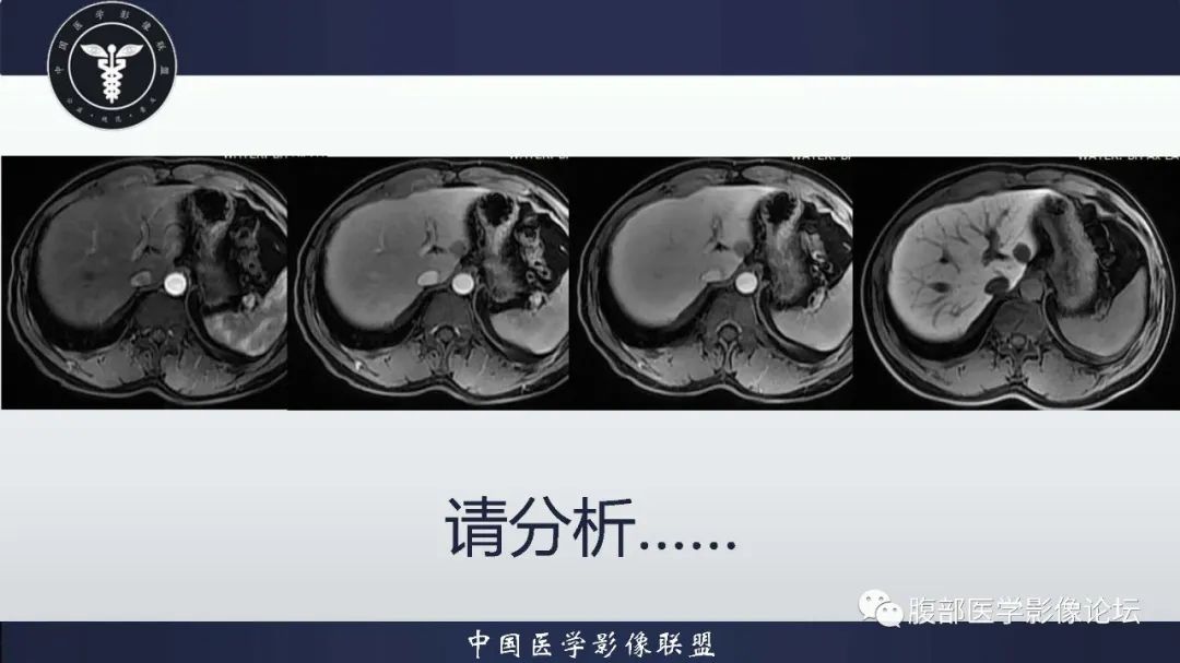 影像PPT - 【病例】肝脏血管平滑肌脂肪瘤1例CT及MR-7