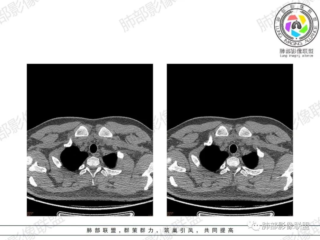 影像PPT - 【病例】胸腺增生1例CT影像讨论-3 影像PPT - 【病例】胸腺增生1例CT影像讨论-3