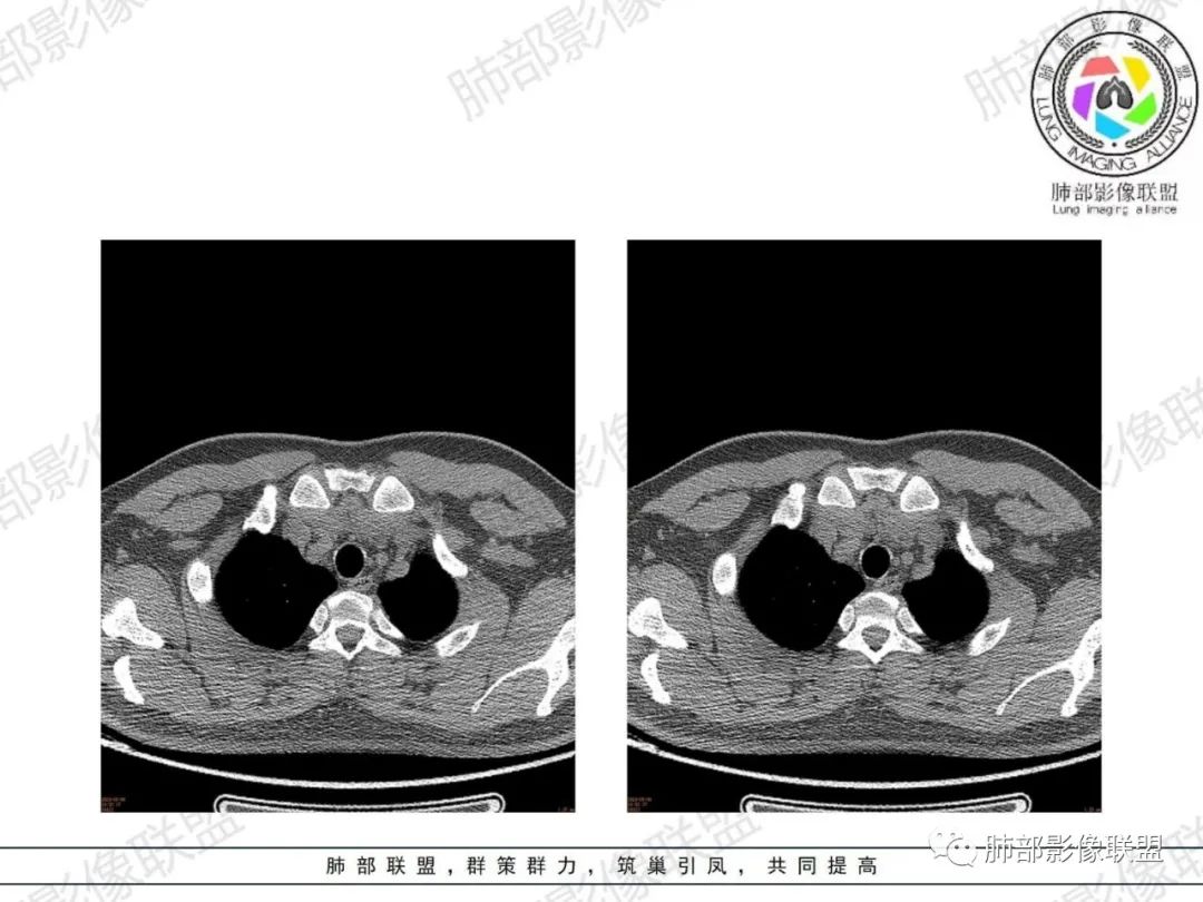 影像PPT - 【病例】胸腺增生1例CT影像讨论-4 影像PPT - 【病例】胸腺增生1例CT影像讨论-4